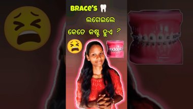 brace's 🦷 କେତେ କୋଷ୍ଟ ହୁଏ? 😫#braces#ytshorts#dayinmylife