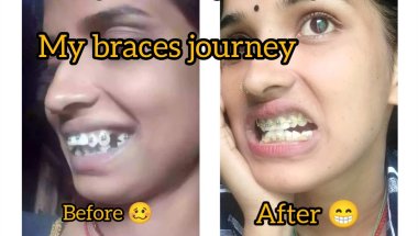 my braces journey braces  experience metalbraces बहूत pain हौताहै timeपे चेक नहीहूwa हे🥴🤔