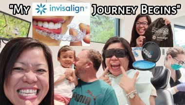 My Invisalign Journey: Day 1 - Trays, Attachments, and True Cost | Part 1 | Tagalog
