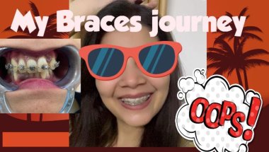 1 year 17 day braces journey#viral #dentist #trending #youtube #dentalcare #teeth #viralvideo