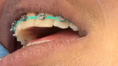 Come with me to get my BRACES TIGHTENED 😩😬🥲
