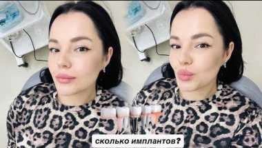 ИМПЛАНТАЦИЯ ЗУБОВ | моя история, отёк и боль