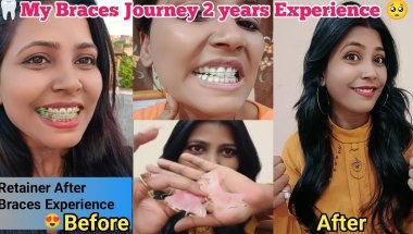 😍🦷MY Braces Journey 2 Years Experience ll My Retainer Speech Patterns One Month After Braces Removal