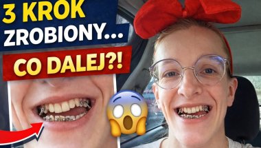 3. etap leczenia… i teraz operacja?! 😱