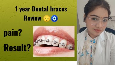 Real Review of dental braces 🧿😌...#dental #medicaleducation