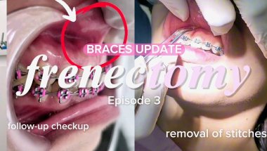 #BracesUpdate🦷: 2-week Healing Update FRENECTOMY | REMOVAL OF STITCHES