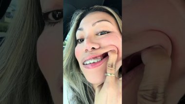 braces journey: Loose Tads/ screw . What happened?