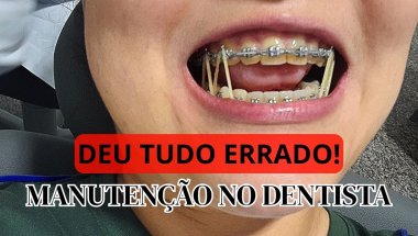 MANUTENÇÃO DO MEU APARELHO NO DENTE #dentista #sorriso