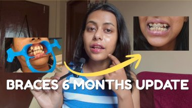 I have had *BRACES* for 6 months now😱🦷and here's what happened
