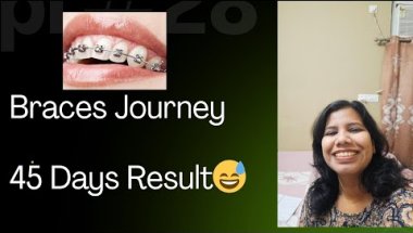 45 Days with Braces | Pain Level, Diet & Visible Changes