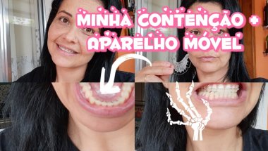 Tudo Sobre Minha Contenção +Meu Aparelho  Móvel/valores |cuidados |manutenção |