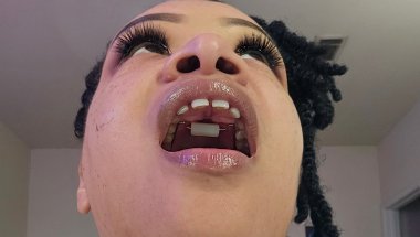My Adult Braces Journey: My Blue Grass Appliance for Tongue Thrust