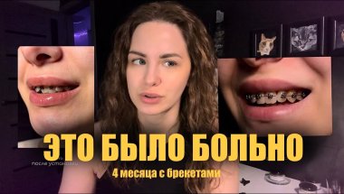 Мой опыт с брекетами 4 месяца • нижняя челюсть - это жесть