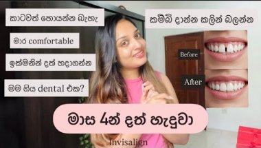 මාස 4න් දත් හැදුවා🦷😌|කම්බි දාන්න කලින් බලන්න💯| Invisalign