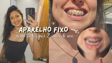resultado de 2 anos com aparelho fixo | o que mudou? quando vou tirar?