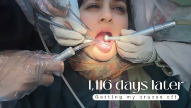 Getting my BRACES OFF *after 3.5 years*😵‍💫
