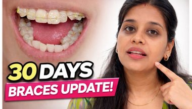 “My First 30 Days With Braces 😬 | Pain, Progress & Real Result! #real #braces #transformation