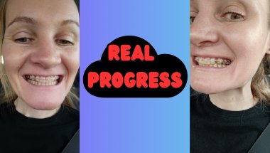 Progress Focused - Update 😁#bracestreatment  #smile #metalbraces #adultbraces #orthodontics