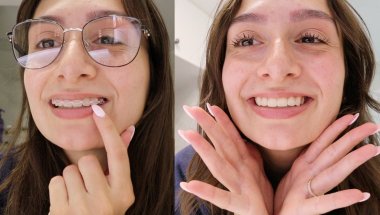 my experience with adult braces at 26