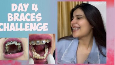 My 1 year 1 month braces tightening update #viral #youtube #dentist #trending #dentalcare #youtube