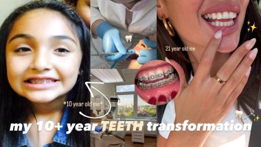 my 10 year teeth transformation vlog *I GOT MY BRACES OFF!!* 🦷🪥⭐️