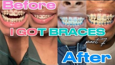 I GOT BRACES!! Part 7 | retighten & color change | Brya Life