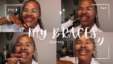 ADULT BRACES JOURNEY | WHY NOW, COST, PAIN, TIMELINE AND MORE…