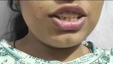 My braces journey🥰! ;(tongue crip removal😇😁#braces #dentist #bracestransformation  #love ❤#doctor..