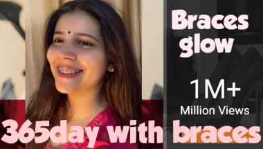 1 year 1 month completed with braces ,lots of think happens with me 🥲#viral #dentist #trending #tee