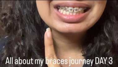 My Braces Journey Begins.Pain,Struggle  Reality #braces #bracesjourney #bracestreatment #braceslife