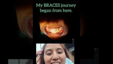 My braces journey...#braces #BracesJourney #dentist #asmr #shorts #viral #trending #short #newtrend