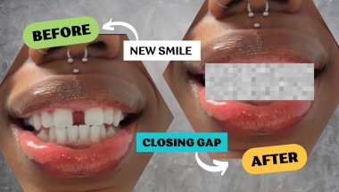 I’m Finally Closing My Gap 😄 | VENEERS?! 🫣 | Invisalign Cost, Pain Level & Why I Did It 🦷