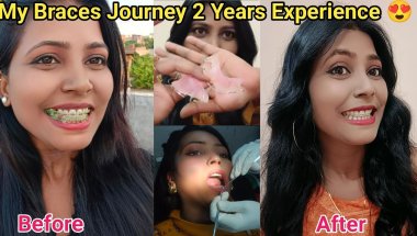 🦷My Braces Journey 2 Years Experience 😍 ll Braces Types, Cost, Time , Pain Nd Family Vlogs