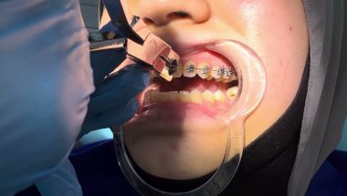 Braces off