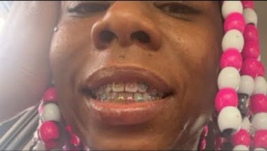 Braces at age 41!
