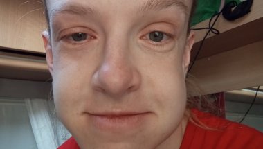 Zrobiłam kortykotomię… 😱 Moja reakcja + wizyta u ortodonty