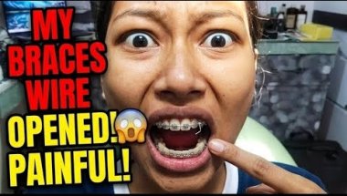 Braces Tightening Gone Wrong 😭 Wire Opened at Home!
