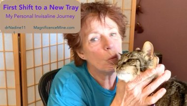 Nadine's Personal Invisalign Journey  - shifting from Tray 1 to Tray 2