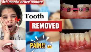 "They Removed My Tooth !!! 😱& 8th Month BracesJourney | Extraction Experience"