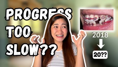 Your Braces are Slow, But They’re Not Broken. Here's Why…