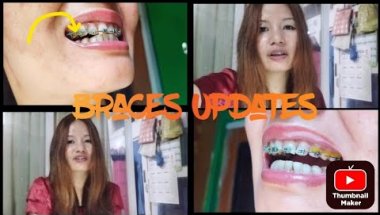 Braces Updates time | braces updates | Improved teeths 90% #bracesupdates  #adultbraces #updates