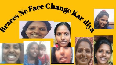 April 5, 2026 Profile Improvement With Braces!  Before & After Transformation@kanaparthiravana1166
