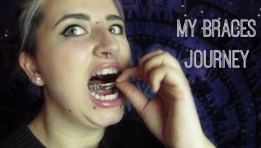 Just don't get braces okay...