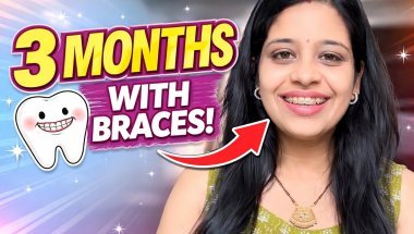 My 3rd Braces Tightening Experience 😬 Real Pain & Truth”