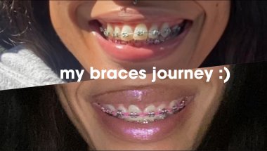 3 YEAR BRACES JOURNEY PT 1 (OVERBITE)