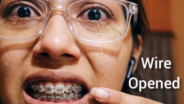 What To Do If Braces Wire Comes Out? 🦷