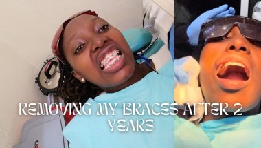 REMOVING MY BRACES AFTER 2YEARS