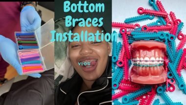 #vlog | Bottom Braces Installation | #tealover