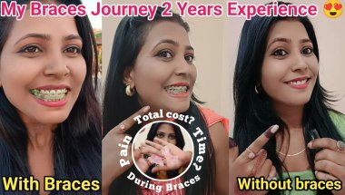 🦷My Braces Journey 2 Years Experience 🥺28 feb 2024 To 25 feb 2026 ll Retainers After Braces Vlog