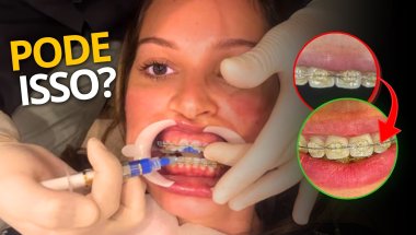 Fiz ESTÉTICA NOS DENTES com APARELHO ORTODÔNTICO